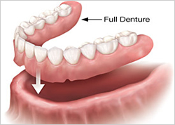 Dental Implant in Surat