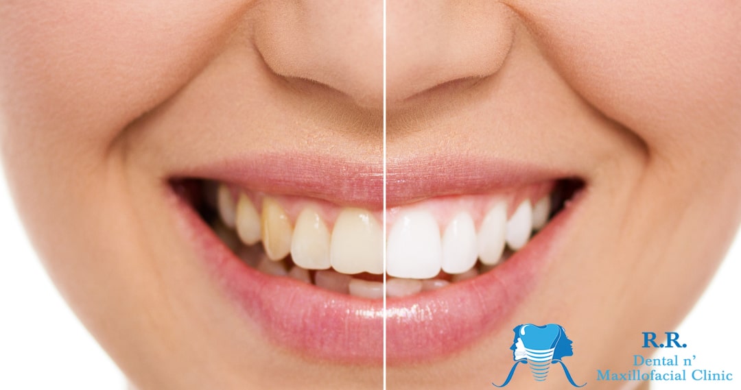 teeth whitening treatment in Surat