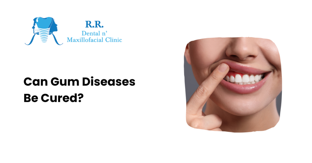 Can Gum Diseases Be Cured?